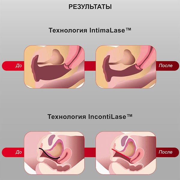 Интимная пластика в Новосибирске в клинике НИИТО